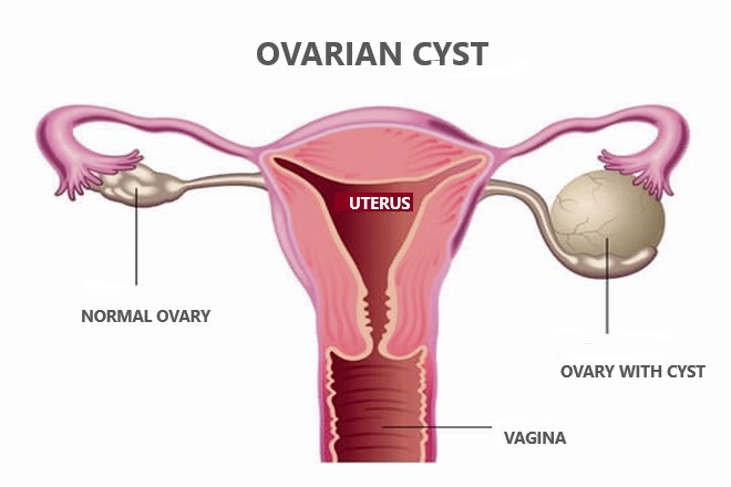 Ovarian Cyst