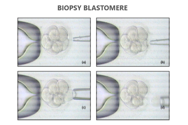 Biopsy_blastomere Biopsy_blastomere