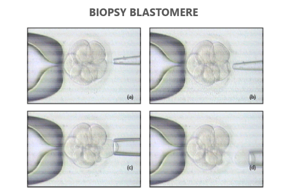 Biopsy_blastomere